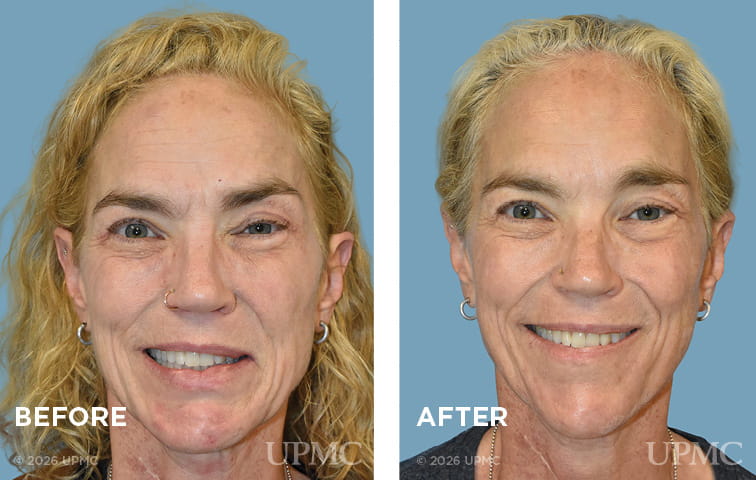 Selective denervation, DAO resection, and Botox for left facial synkinesis due to Ramsay syndrome